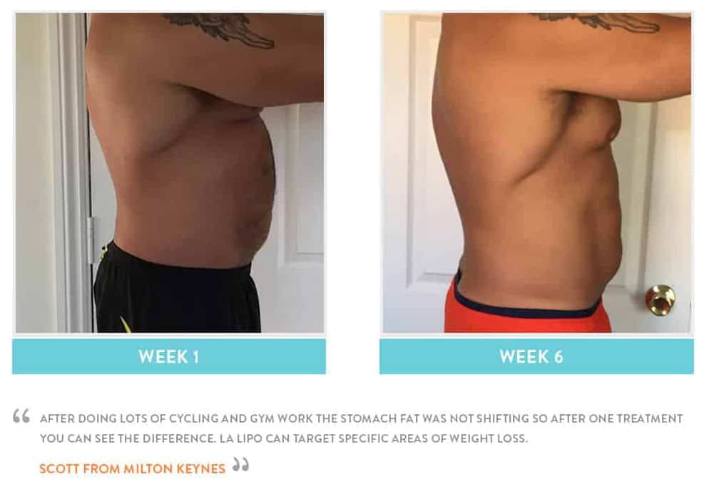 Before & After Stomach Fat Chesterfield