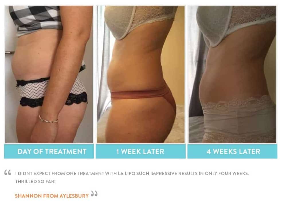 before, Cryolipolysis Chesterfield