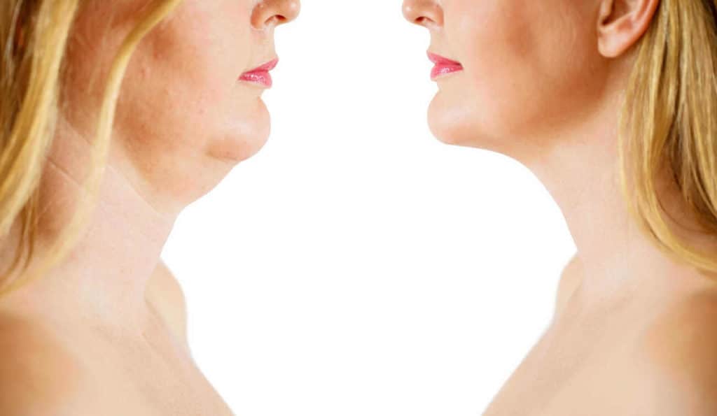 Double Chin treatment Chesterfield before and after results