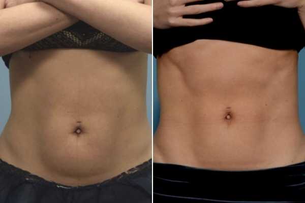 body sculpting FAQs Chesterfield