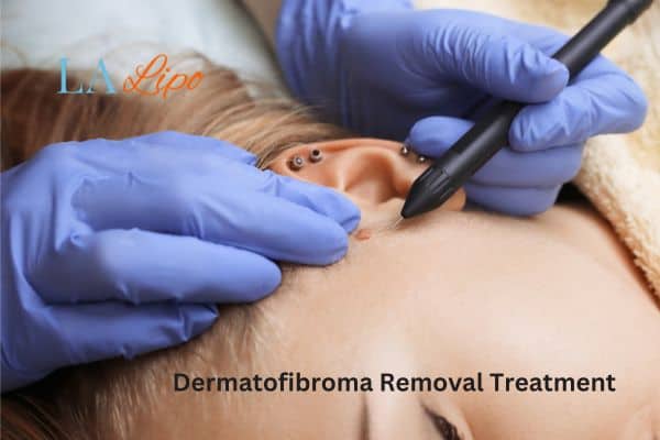 Dermatofibroma Removal Treatment Chesterfield