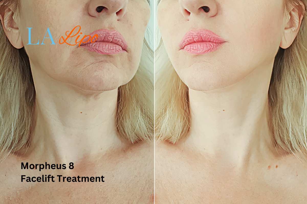 Turn back time with Morpheus8 Treatment Chesterfield