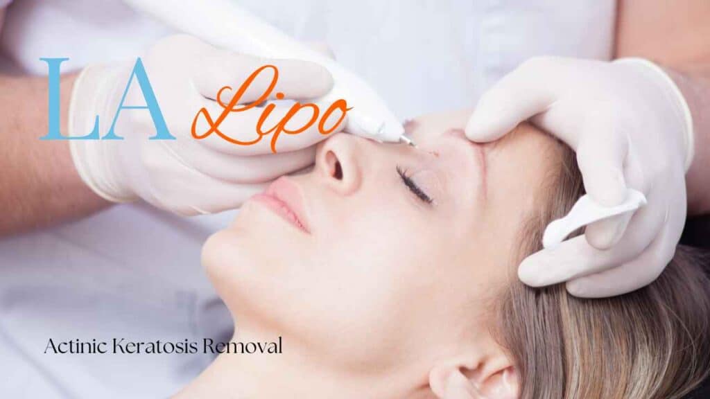 actinic keratosis removal Chesterfield