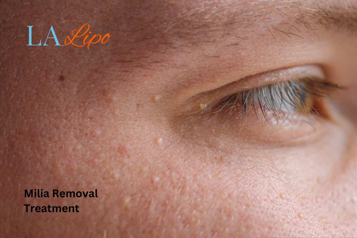 Cryopen Milia Removal: Is It the Easiest and Safest Option Chesterfield?