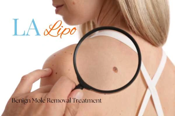 Why getting moles removed Chesterfield can boost your confidence!