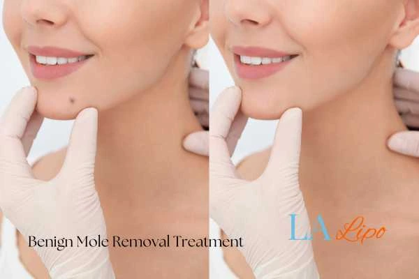 woman's before and after mole removal Chesterfield results