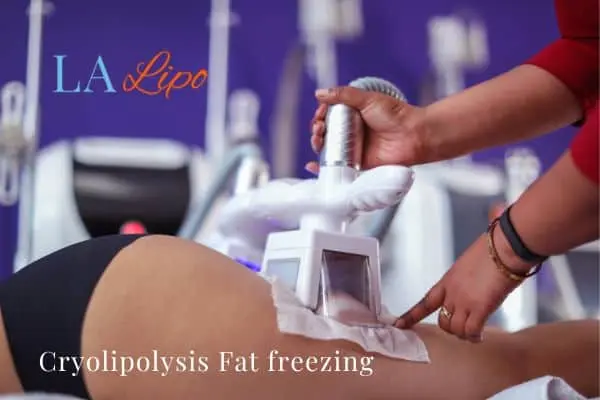 women getting fat freezing Chesterfield