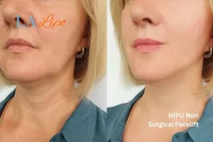 hi-fu for wrinkles Chesterfield before and after results