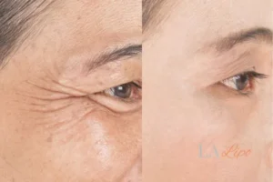 Before and after results of woman - HI-fu wrinkles reduction treatment Chesterfield