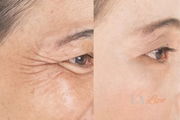 Before and after results of woman - HI-fu wrinkles reduction treatment Chesterfield