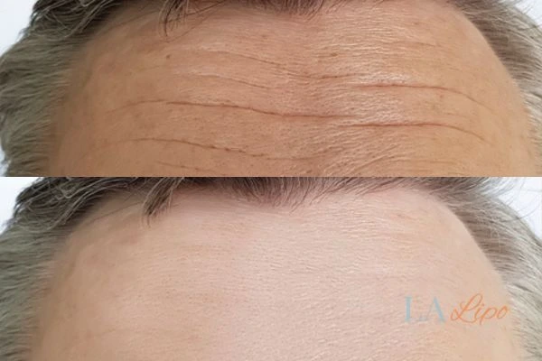 results of HIFU Chesterfield on mans forehead to help reduce lines and wrinkles