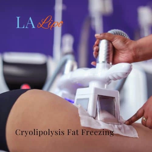 fat freezing - Cryolipolysis Chesterfield