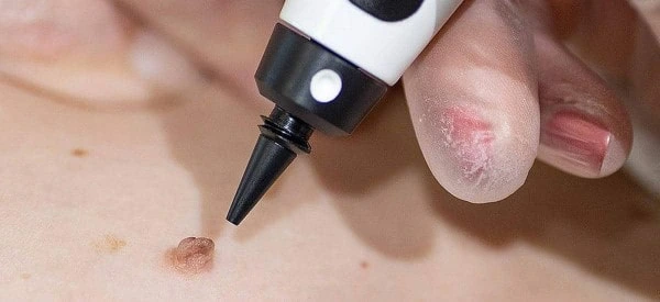 skin tag removal using cryopen Chesterfield