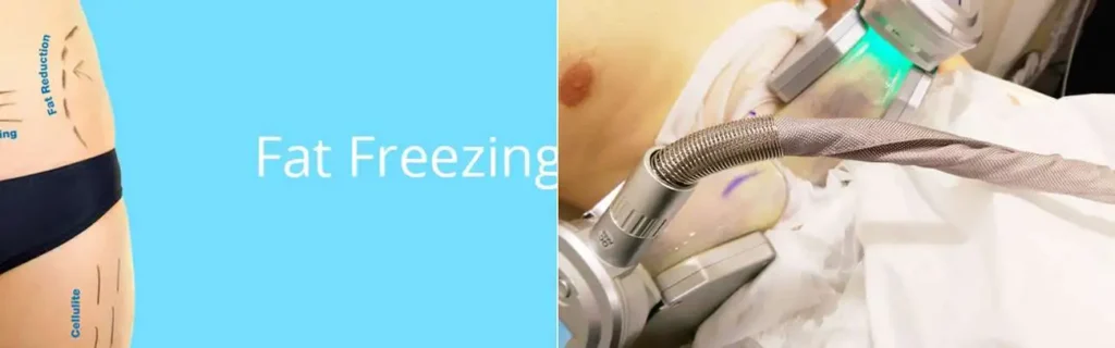 multi areas of a persons body having coolsculpting Chesterfield treatment