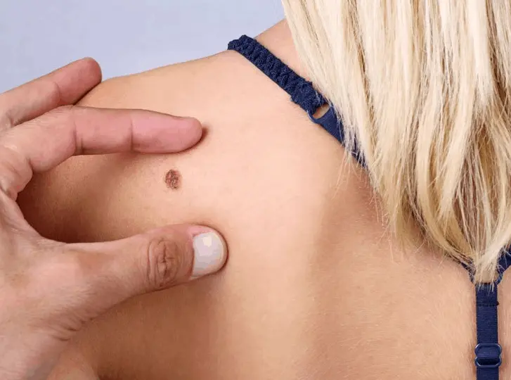 woman having mole removal Chesterfield consultation before treatment.
