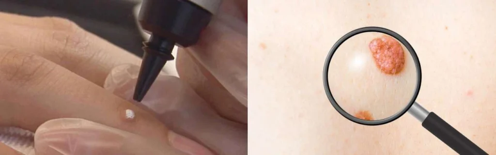 Person getting moles removed with cryopen Chesterfield