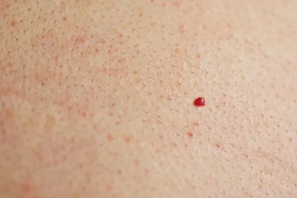 close up of a cherry angioma Chesterfield