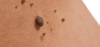 image of a skin tag Chesterfield