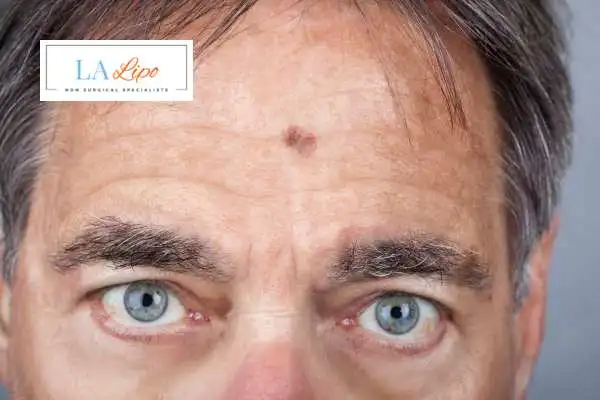 Solar Lentigo Removal Chesterfield image of man with mark on his forehead