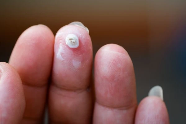 wart on person finger - cryotherapy to treat from LA LIPO Chesterfield