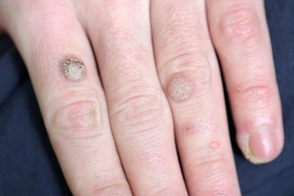 photo of warts on person hand - see wart removal Chesterfield from LA LIPO