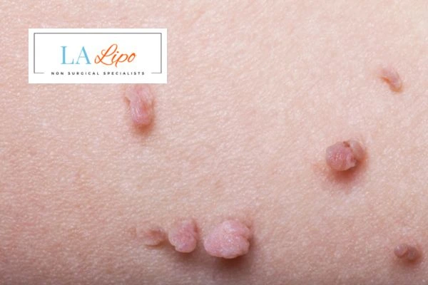 Does cryopen skin tag removal Chesterfield hurt? Find out now call our team today!