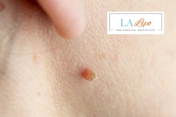 Book skin tag removal Chesterfield today speak to our team now!
