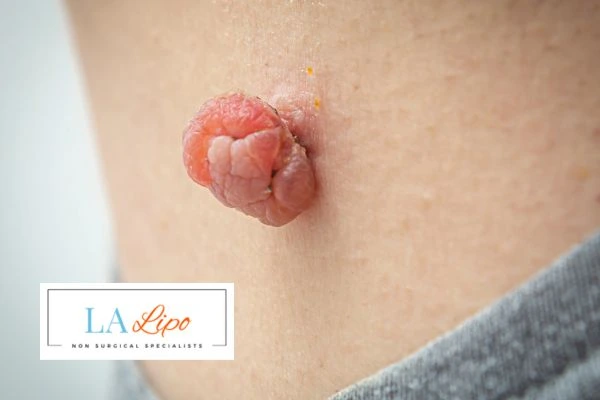 Interested in skin tag removal Chesterfield? Concerned about the pain? Find out more today!