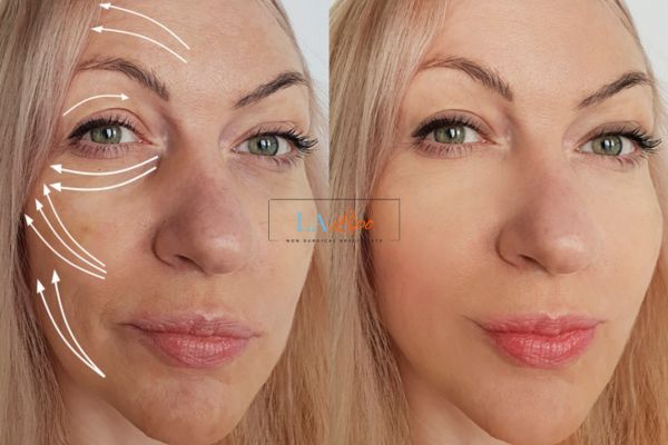 Morpheus 8 results Chesterfield face lift.