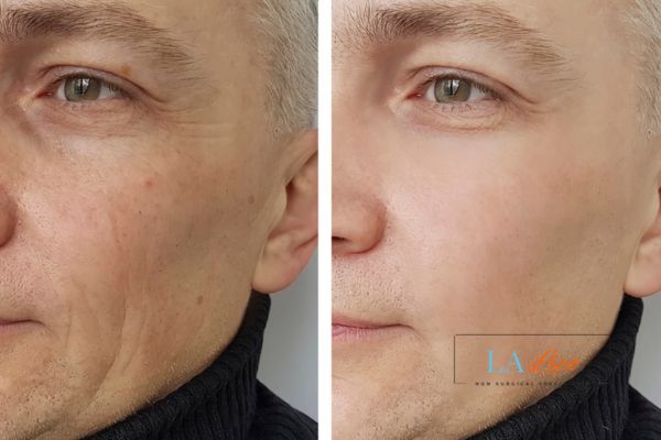 See the amazing results of Morpheus8 Treatment Chesterfield!