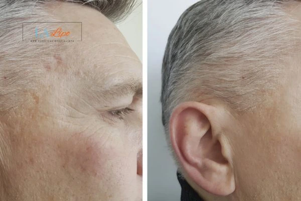 Mens Before & After Morpheus 8 Results Chesterfield
