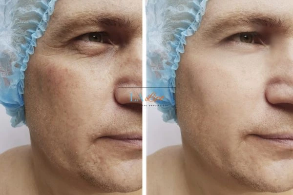 Before and after Morpheus 8 Results Chesterfield