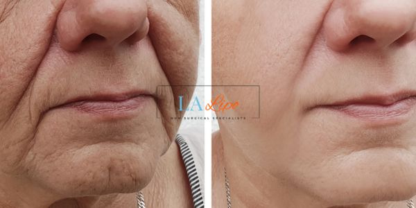 Older lady deeper wrinkle reduction - LA LIPO Morpheus 8 Results Chesterfield