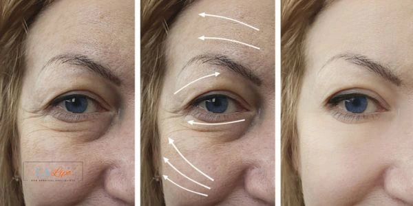Amazing eye lift Morpheus 8 results Chesterfield