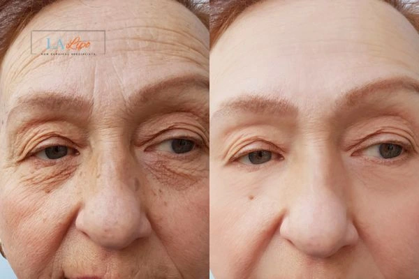 The powerful benefits of Morpheus8 Treatment Chesterfield - Call Our team today!