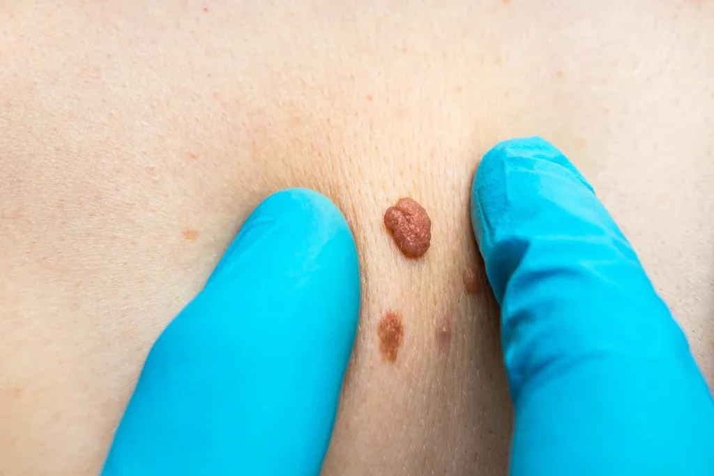 LA LIPO Cryopen Lesion Removal Prices Chesterfield