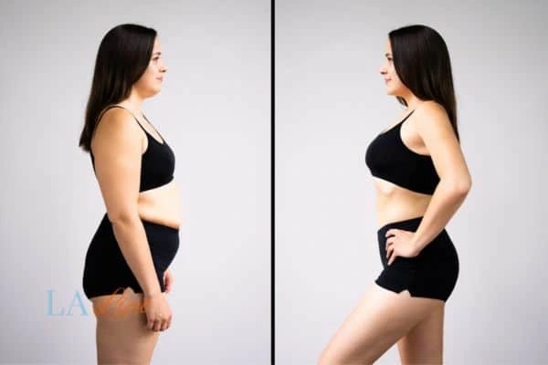 Picture of womans before and after using LA-EMS body sculpting to improve her core strength Chesterfield