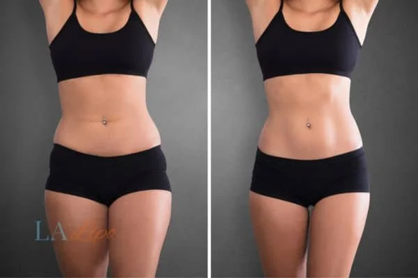 before and after results of non-surgical treatment to help a woman's body image and mental health Chesterfield
