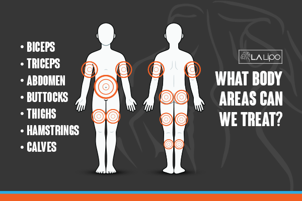 Diagram to show areas you can have LA-EMS Body Sculpting Treatment Chesterfield