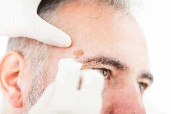 Age spots and elderly people Chesterfield what is the link?