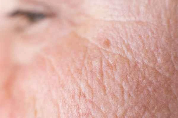 close up picture of a woman's face showing an age spot Chesterfield