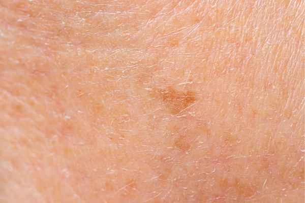 close up picture of age spots Chesterfield