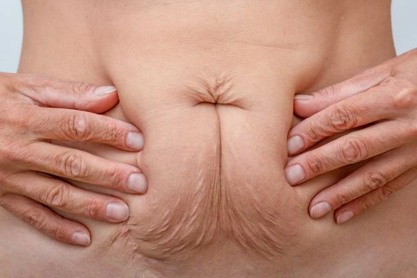 Image of a woman's stomach with loose skin - example of skin tightening Chesterfield options