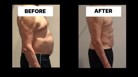 What Symptoms Can Diastasis Recti Cause in Men? Weak Core, Back Pain and Poor Posture Chesterfield
